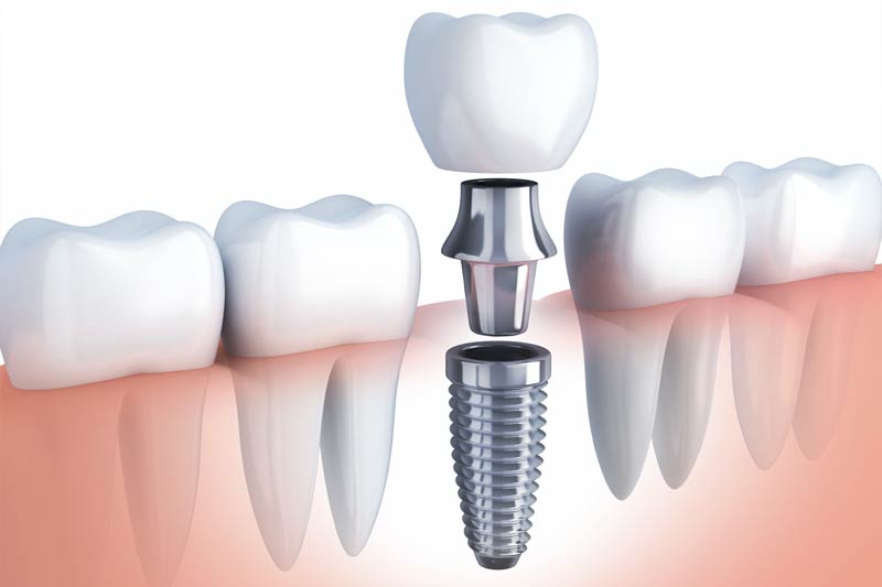 Implants Dentist in Riverside